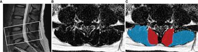 Association of Paraspinal Muscle CSA and PDFF Measurements With Lumbar Intervertebral Disk Degeneration in Patients With Chronic Low Back Pain